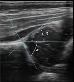 Useful ultrasound measures in neonatal hip sonography, alpha and beta angles.[1]