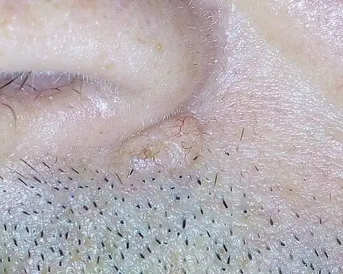 Basal-cell carcinoma (BCC)