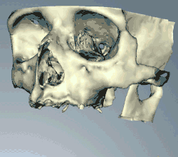 CT scans can be loaded to CAD/CAM software to create a simulation of the desired treatment. Virtual implants are then placed and a stent created on a 3D printer from the data.