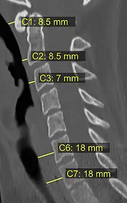 CT scan with upper limits of the thickness of the prevertebral space at different levels[8]