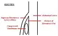 A diagram of a compressed duodenum due to a reduced mesenteric angle.