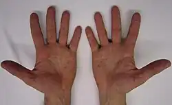 Rash on palms of the hands
