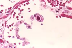 CMV infection of a human lung pneumocyte