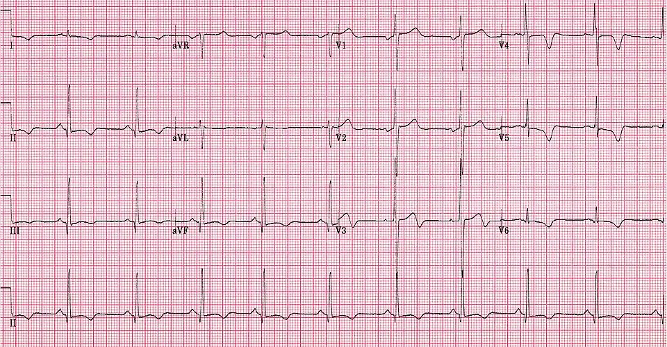 ECG showing HOCM
