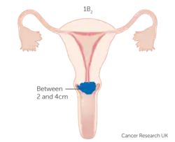Stage IB2 cervical cancer