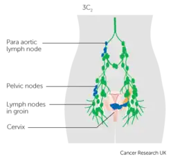 Cervical cancer stage IIIC2