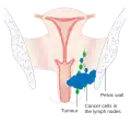 Stage 3 vaginal cancer
