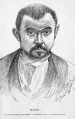 A sketch showing hypomimia, a blank, expressionless face