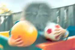 Central field defect in macular degeneration[33]