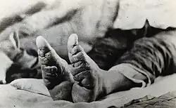 feet of a Chinese woman in an isolation hospital in Mauritius