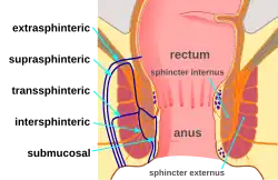 This is a modified version of the original by Armin Kübelbeck [CC BY 3.0 (http://creativecommons.org/licenses/by/3.0)], via Wikimedia Commons, https://commons.wikimedia.org/wiki/File%3APiles_diffdiag_01.svg Specifically, it was made fistula-specific by removing abscess labels.