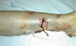 Gustilo type I open fracture