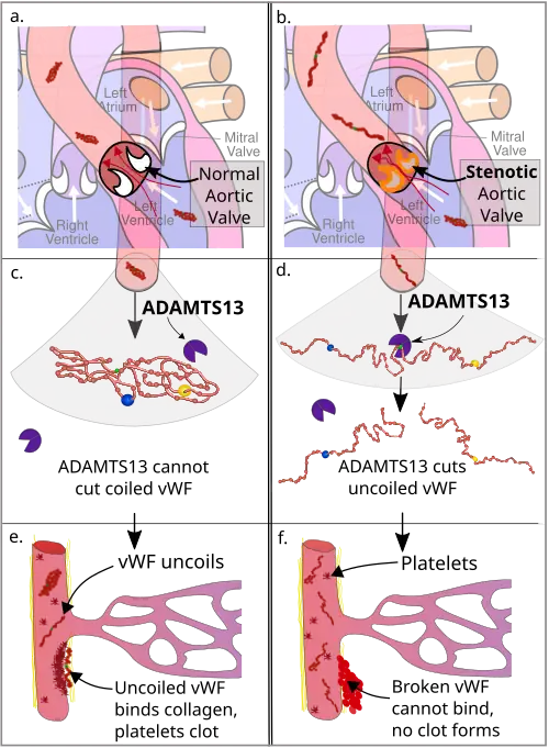Diagram of the pathophysiology of Heyde's syndrome