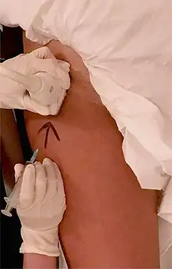 Ultrasound-guided hip joint injection