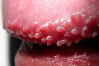 Glans penis with Hirsuties papillaris penis. Papules are common on uncircumcised penises.