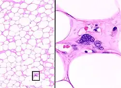 Histopathology of the major differential diagnosis of a well-differentiated liposarcoma, lipoma-like subtype: It looks almost identical at low magnification, but a high magnification of a fibrous band shows spindle cells with enlarged, hyperchromatic nuclei. H&E stain.