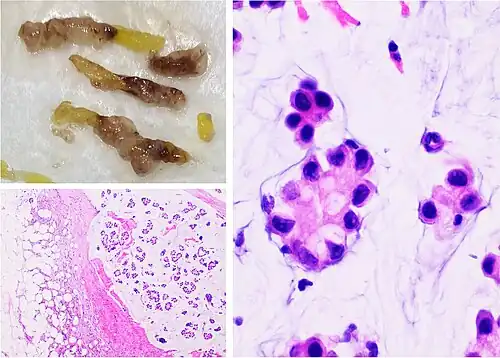 Mucinous carcinoma of the breast: Gross pathology (upper left) of mucinous carcinoma shows gelatinous areas. Histopathology shows clusters or nests of tumor cells floating in pools of extracellular mucin.[3]