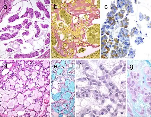 Mucinous thyroid carcinoma (a) showing abundant mucoid material mucicarmine positive (b); most tumor cells were positive for thyroglobulin (c). In this mucinous variant of follicular thyroid carcinoma (d), the follicles were distended and full of Alcian blue–positive mucinous material (e). Mucinous variant of papillary thyroid carcinoma (PTC) (f), the tumor showed ribbon, trabecular and/or follicular pattern, classic nuclear features of PTC and abundant mucoid stroma positively stained with Alcian blue (g)[9]