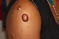 Keloid nodules (1–2&nbsp;cm in diameter) and a keloid tumor >2&nbsp;cm in diameter