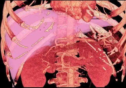 MDCT image. 3D image created by MDCT can clearly visualize the liver, measure the liver volume, and plan the dissection plane to facilitate the liver transplantation procedure.