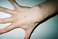 Hand of 37-year-old patient showing interdigital webbing