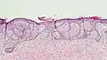 Fibroepitheliomatous pattern (anastomosing basaloid epithelial strands enclosing round islands of fibrous stroma)[36]