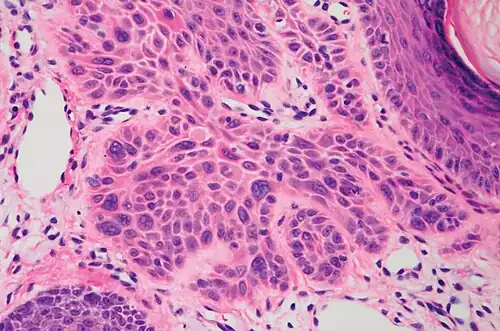 High magnification demonstrates the pleomorphism of the invading keratinocytes[12]