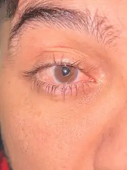 Mohammad Farzi's right eye, the pupil is uneven and the eye is red.