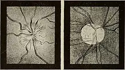 The illustration on the left depicts optic neuritis. The illustration on the right depicts atrophy of the optic nerve.