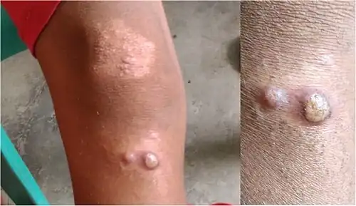 Here, two different appearances (papulosquamous plaque and yellow-crusted nodules) are seen in the same 10-year-old (large-scale of both, close-up of nodules)