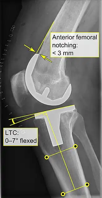 - Anterior femoral notching (the femoral component causing reduced thickness of the distal femur anteriorly), seems to cause an increased risk of fractures when exceeding about 3&nbsp;mm.[64] - LTC: lateral (or sagittal) tibial component angle, which is ideally positioned so that the tibia is 0–7° flexed compared to at a right angle with the tibial plate.[63]