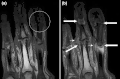 Coronal T1-weighted MRI of fingers in PsA. (a) Pre- and (b) post-contrast showing active synovitis at proximal and distal interphalangeal joints (large arrows), joint space narrowing, bone proliferation at proximal interphalangeal joint, erosions at distal interphalangeal joint (white circle), enthesitis medial to proximal interphalangeal joints.