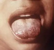 A neglected child presenting a "scorbutic tongue" due to vitamin C deficiency