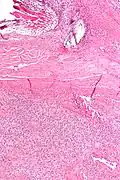 Solitary fibrous tumor - low magnification. H&E stain.