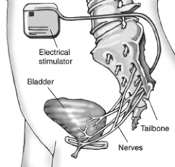 Illustration showing the placement of the sacrla nerve stimulator in the abdomen in relation to the bladder, sacral nerves and lower spine.