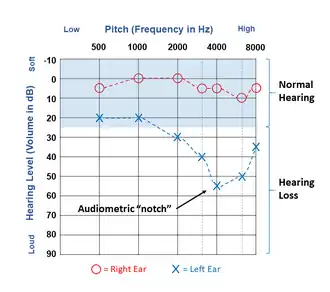 Results of a hearing test plotted on an audiogram illustrating a typical "noise notch" in the left ear