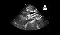 Ultrasound showing SMA syndrome[18]