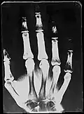 Original: X-Ray image of right Hand; 1st. order equidensities after pseudo-solarization of original
